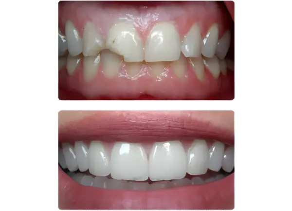 dentist-north-york-porcelain-veneers