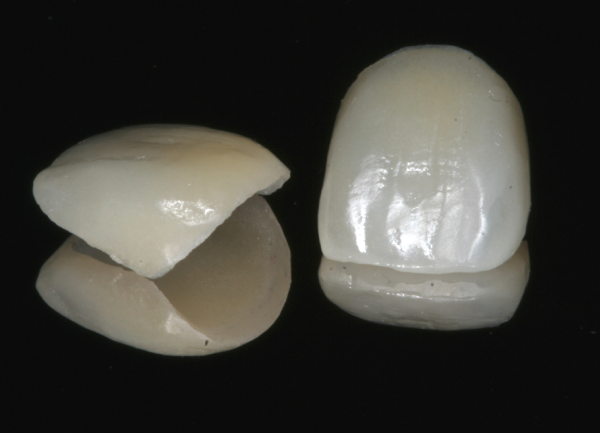 dentist-north-york-veneer