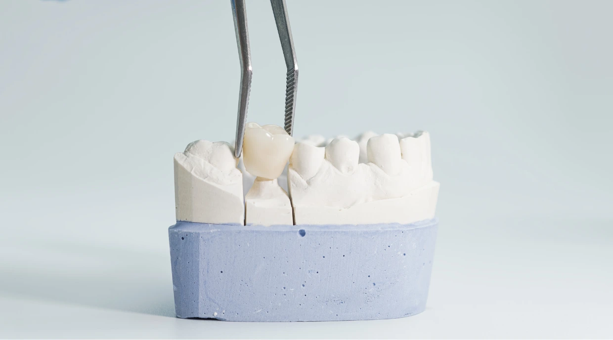 Crown Dentist North York