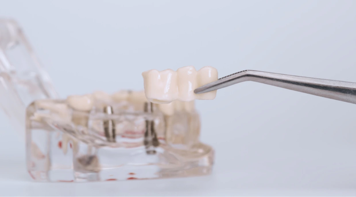 Dental Bridge Dentist North York