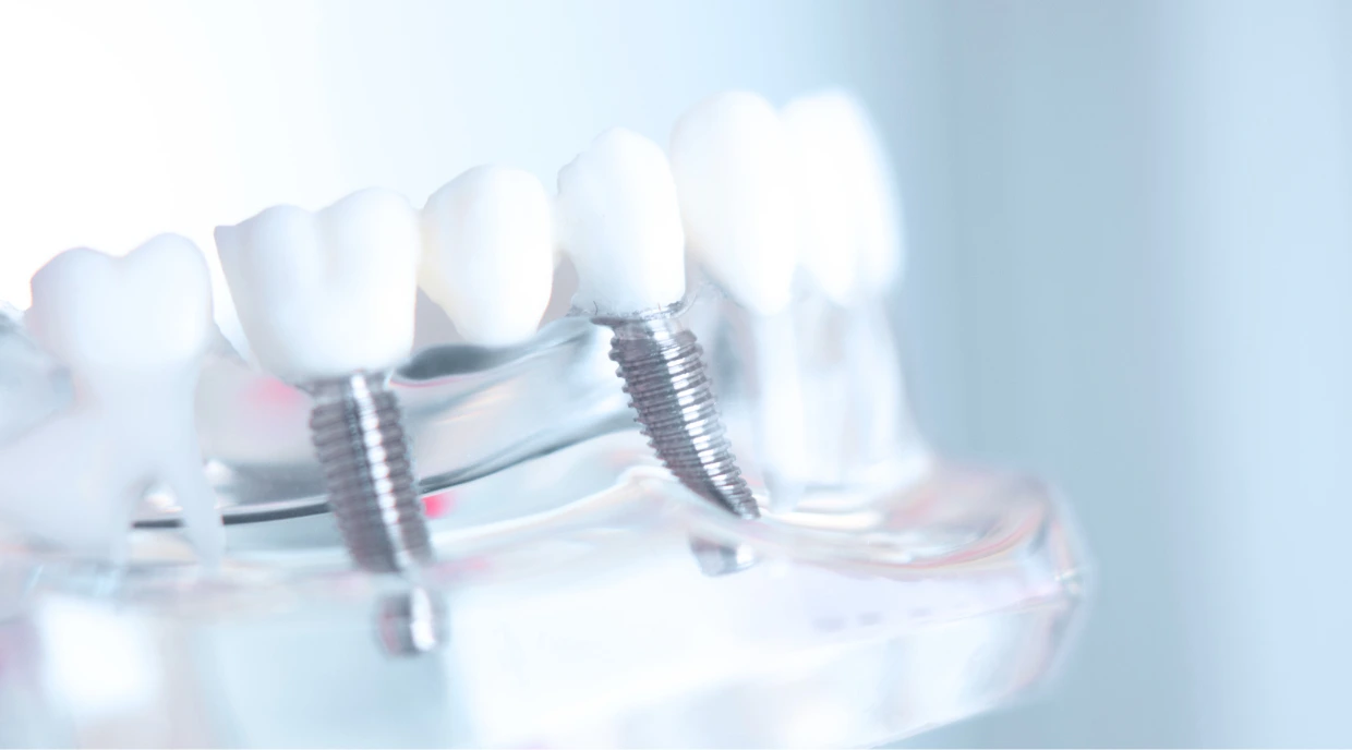 Dental Implant Missing Teeth North York