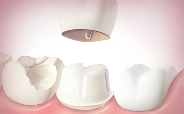 dentist-north-york-crown
