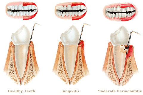gumdiseasephoto